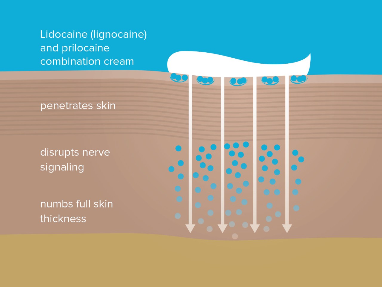 The numbing process schematic