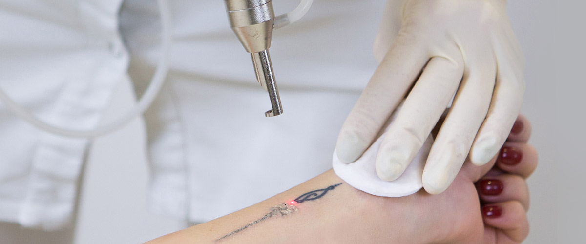 tattoos that is removed using laser